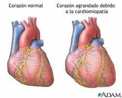 Miocarditis, miocarditis neom, miocarditis no especificada, miocarditis, sai, inflamación miocárdica (hallazgo), miocarditis, sai (trastorno), myocarditis nos, inflamación miocárdica. Preguntas Al Dr Garber El Nuevo Herald