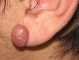 They occur most often when there's too much tension around a healing wound. Keloid And Hypertrophic Scar Dermnet Nz