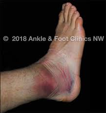 See full list on ehealthwall.com Seattle Ankle Sprain Pain Doctor Everett Wa Podiatry