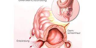 Warum das reizdarmsyndrom einst als schleimige colitis bezeichnet wurde. Darmdurchbruch Darmperforation Heilpraxis