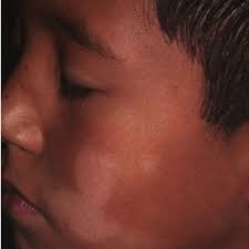 Beeswax is used for high. Pa Lesion Treated With 0 1 Tacrolimus Ointment In A 7 Year Old Boy Download Scientific Diagram