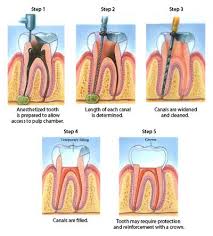 How to tell if you need a filling. Baton Rouge Root Canal Treatment