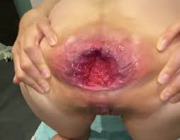 M687pro has the biggest anal gape in the world?