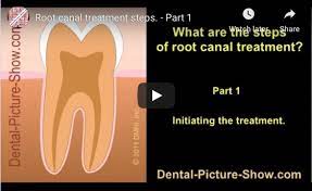 Here S A Comprehensive Video Showing The Various Steps Of A Rootcanaltreatment Recommendeddentistsinsurre Root Canal Root Canal Treatment Dental Restoration