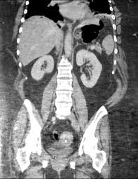 He or she can also tell how well you're. Collection Due To Leak After Sleeve Gastrectomy Radiology Case Radiopaedia Org