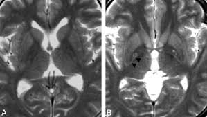 Linear T2 Hyperintensity Along The Medial Margin Of The Globus Pallidus In Patients With Machado Joseph Disease And Parkinson Disease And In Healthy Subjects American Journal Of Neuroradiology