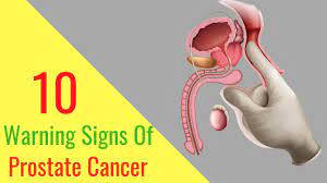 Prostate cancer is one of the most common types of cancer diagnosed in men. Prostate Cancer Symptoms 10 Warning Signs Of Prostate Cancer You Should Not Ignore Youtube