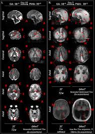 Development of neonatal-specific sequences for portable ultralow field  magnetic resonance brain imaging: a prospective, single-centre, cohort  study - eClinicalMedicine