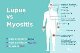 Here's everything you need to know about treatment for lupus and how your rheumatologist can help you. Lupus Vs Myositis Differences In Symptoms And Treatments