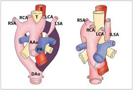 The presence of atherosclerotic plaques and their influence on the vertebral artery is of clinical importance within the scope of spinal manipulation. Xmlinkhub