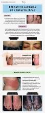Image result for dermatitis contacta allergica