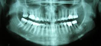 Some of the most common oral cancer symptoms and signs include: Oral Cancer Do You Know The Risk Factors