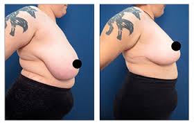 It is not known if altreno will harm your unborn baby. How To Get Insurance Coverage For Breast Reduction Dr Mowlavi