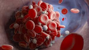 .thrombose, survenue deux semaines après l'injection d'une première dose de vaccin astrazeneca, indiquent des 14 jours après l'injection, elle a fait une thrombose, et dû être hospitalisée à purpan. Mieux Comprendre Les Thromboses Liees Au Vaccin D Astrazeneca Tout Un Matin