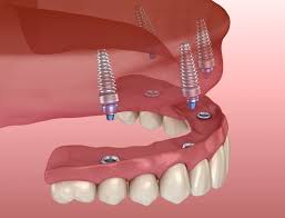 Does insurance cover tooth implants. How Many Teeth Can Dental Implants Replace