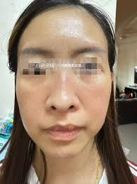 顾客做了定点式双眼皮+无痕抽脂后第五天效果,非常自然不影响日常生活询问/预约： wechat