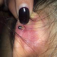 Is My Ear Piercing Infected Shouldn T Takeout Out I Got It Don T Last Month Still Hurts And This Bump Just Popped When I Hit It Help Glow Community