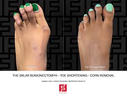 Image result for Corns