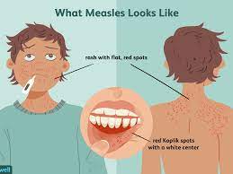 Measles Prevention