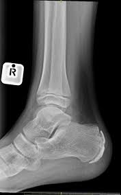 Image result for Calcaneal Apophysitis