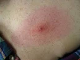 Image result for infected tick bite
