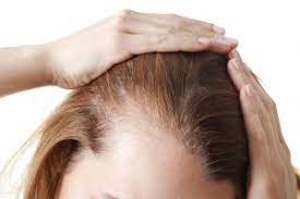 Haarausfall Bei Frauen Die Haufigsten Formen Beethoven 5 13 Klinik