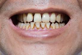 How to remove brown coffee stains from teeth. Teeth Whitening The Definitive Guide For 2021