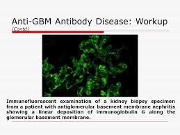 For more information about the disease, please go to the disease information page. Anti Glomerular Basement Membrane Disease Ppt Video Online Download