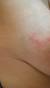Red Spot On Breast No Pain