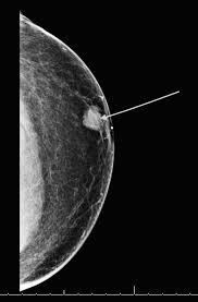 What do breast lumps feel like? Men With Breast Cancer Have Higher Mortality Than Women National Cancer Institute