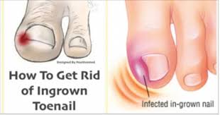 Natural Home Remedy For Ingrown Toenails Ingrown Toe Nail Toe Nails Nail Remedies