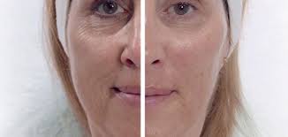 Learn about Visible Age Reverse, the only procedure that remarkably  restores youthful skin