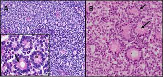 Retinoblastoma protocol applies to retinoblastoma only. Histopathological Characteristics And Classification For Prognostic Indicators Intechopen