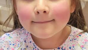 Fifth disease virus symptoms and precautions