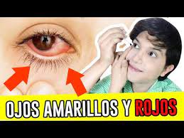 Como Blanquear Los Ojos Amarillos Y Rojos Con Remedios Caseros Aclarar Los Ojos Andyzaturno Youtube