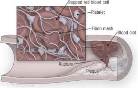Image result for Angina Pectoris