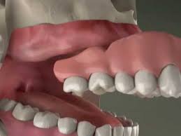 How much is a set of dentures. Dentures Cost Guide Premium Vs Cheap And Which Are Best Electric Teeth