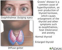 Hi, for graves disease pls consult a acupuncture treatment. Graves Disease Information Mount Sinai New York