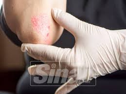Selain sebagai lalapan serta digunakan untuk menurunkan tekanan darah, anda juga bisa. Kim Kardashian West Pun Kena Psoriasis