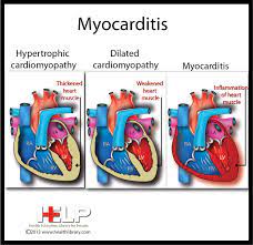 Even before the pandemic, myocarditis was a leading cause of death in young, otherwise healthy. 36 Myocarditis Ideas Inflammation Of The Heart Heart Muscle Rheumatic Fever