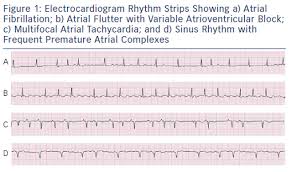 Atrial Fibrillation Optimizing Heart Rate