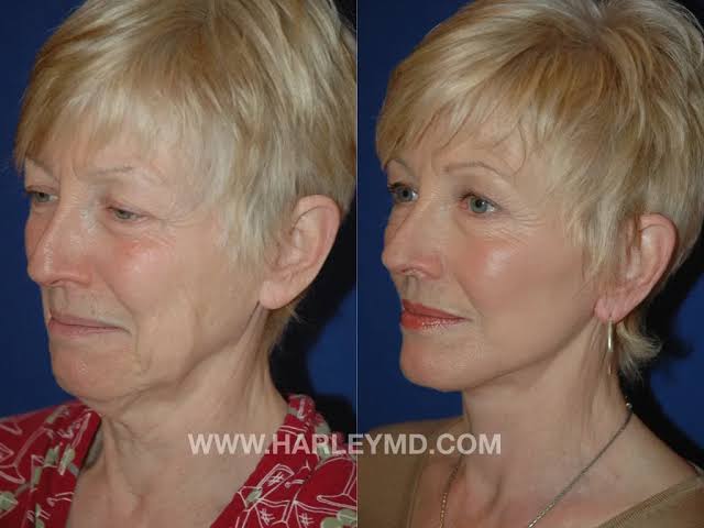 Deep Plane Facelift In North Carolina | HarleyMD