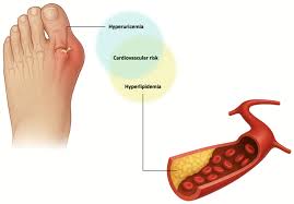 Image result for Hyperuricemia