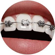 Dublin orthodontist is giving free braces to one lucky person to the value of €4000. Odl Dental Clinic Orthodontics London Odl Dental Clinic Orthodontics Affordable Braces London