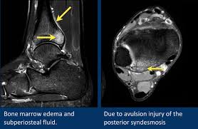 Use your muscles to pull them away from each other and toward your other toes. The Radiology Assistant Mri Examination Of The Ankle