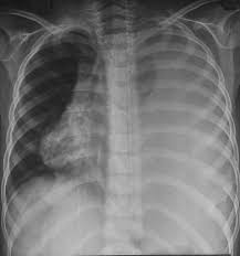 Ewing Sarcoma Of The Chest Wall Radiology Case Radiopaedia Org Sarcoma Radiology Ewing S Sarcoma