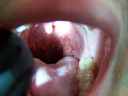 What is hpv (human papillomavirus)? Human Papillomavirus And Throat Cancer Do I Have Hpv Throat Cancer