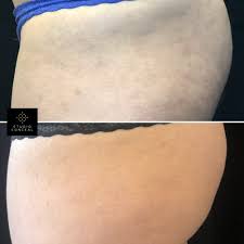 Then remember that the result of getting a tattoo over stretch mark surely differs and. Arms And Butt Stretch Mark Tattoo Cover Up