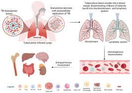 Image result for Extrapulmonary Tuberculosis