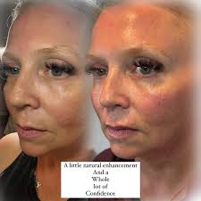 ✨She didn't want pillow face. She didn't want fake. She just wanted her  face… but fresher. ✨ For years, the lines above her mouth had been her  least favourite feature. This week,